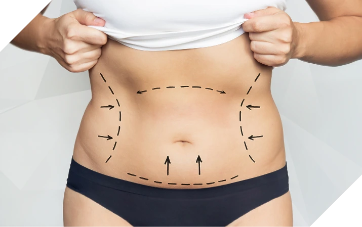 Imagem Cirurgia Plástica Pós-Bariátrica
